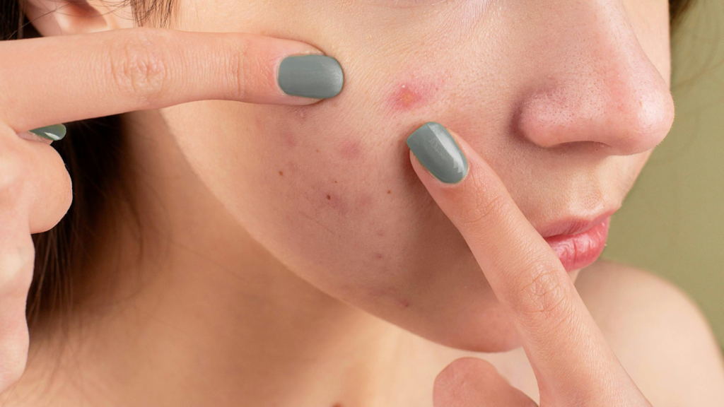 acne skin issues